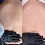 Сыворотка для микронидлинга Skinsculpt Stretch marks formula 30 мл, фото 7